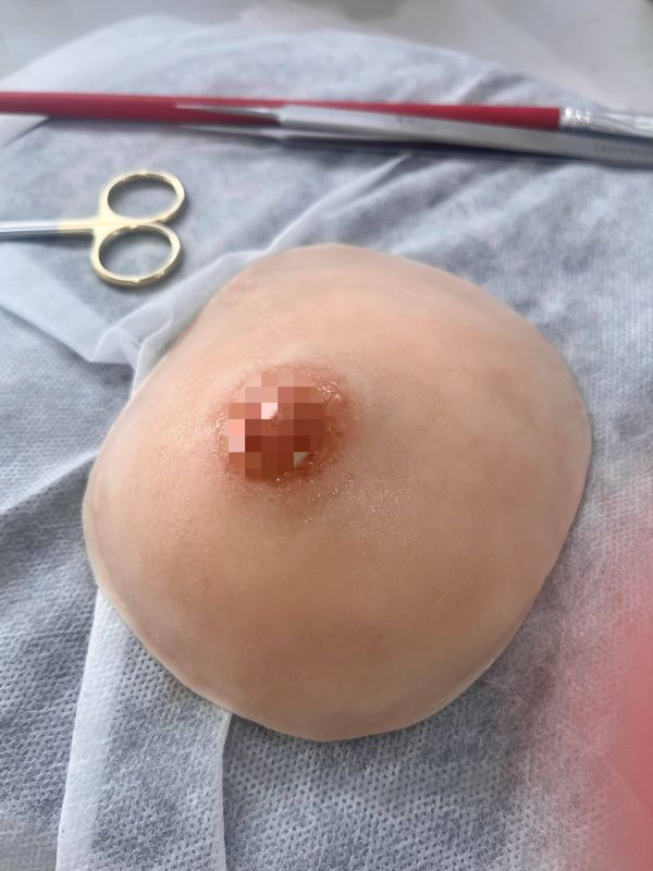 breast prosthesis-